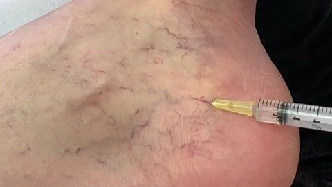 Curso teórico de PEIM - Procedimento Estético Injetáveis para Microvasos — imagem 5