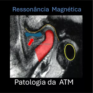 Imagem de capa para o Curso online Ressonância Magnética das artropatias temporomandibulares