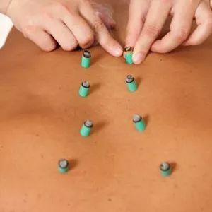 Imagen de portada para Curso online Puntos Shu y Moxibustion para el dolor 