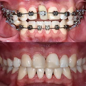 Imagem de capa para o Curso online Mecânica de Fechamento de Espaços - Diastemas, Extrações, Agenesias e Outros.