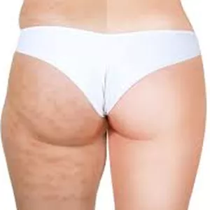 Imagem de capa para o Ebook 45 dias para perder a celulite e estrias