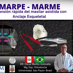Imagen de portada para Curso online MARPE - MARME  "Expansión rápida del Maxilar asistida con Anclaje Esqueletal"