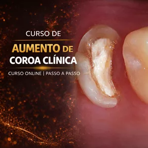 Imagem de capa para o Curso online Curso Online do Passo a Passo do Aumento de Coroa Clínica
