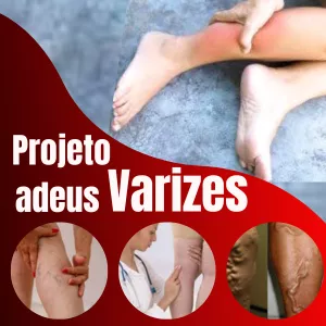 Imagem de capa para o Ebook Varizes adeus