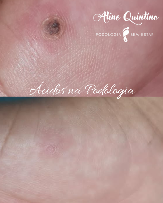 Imagem de Podologia com ácidos criado por Profª. Esp. Aline Quintino na hotmart