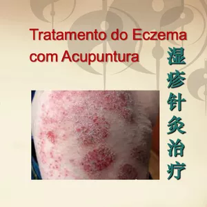 Imagem de capa para o Curso online Tratamento do Eczema com Acupuntura (Disponível só por 45 dias)