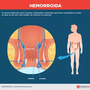 Imagem de capa para o Ebook Alívio na Hemorróida: Um Guia Completo para o Tratamento e Prevenção