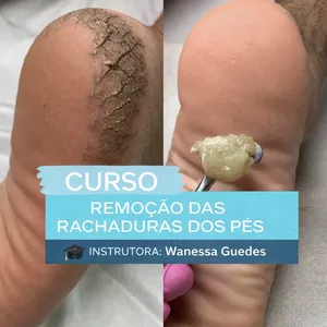 Imagem do curso Curso profissional Podol Asperezas,Calosidades e Tratamento De Tachaduras Calcâneas