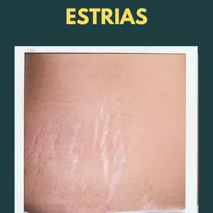 Imagem de capa para o Ebook 10 Receitas Caseiras para Reduzir Estrias