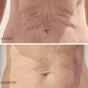 Imagen de portada para Curso online Adíos Flacidez