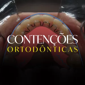 Imagem de capa para o Curso online Contenções Ortodônticas