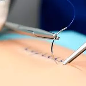 Imagen de portada para Curso online CURSO BÁSICO DE SUTURAS PARA ENFERMERÍA