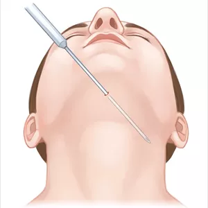 Imagem de capa para o Curso online Lipoaspiração Mecânica de Papada e Lipoescultura Cervical Mecânica
