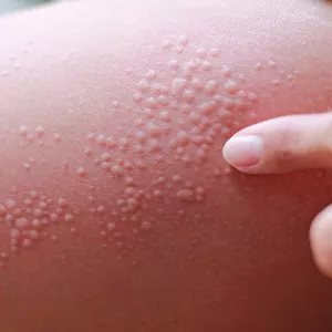 Imagem de capa para o Ebook Resumo de Lesões elementares em Dermatologia 