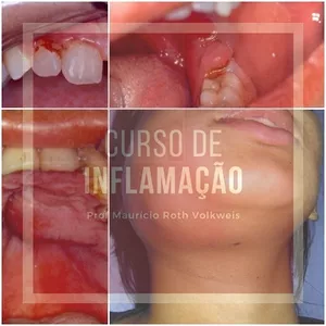 Imagem de capa para o Curso online Curso de Inflamação, Descomplicando e entendendo o processo inflamatório