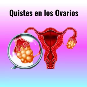Imagen de portada para Ebook QUISTES EN LOS OVARIOS (PDF)