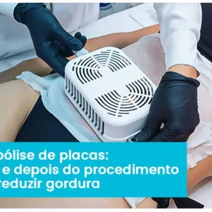 Imagem do curso Criolipólise de Placas&nbsp;