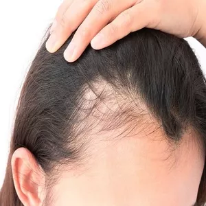 Imagem de capa para o Curso online Tratamento Alopécia/ Estimulo de crescimento , Barba, Sobrancelha e  Capilar