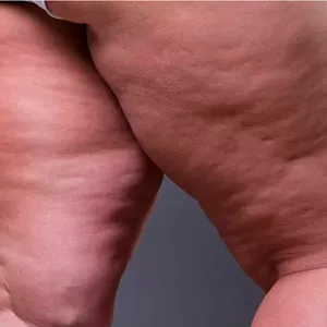 Imagen de portada para Curso online Cero Celulite e Flacidez