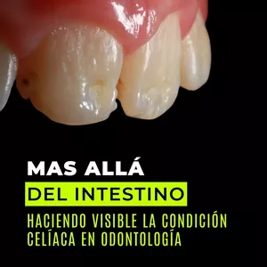 Imagen de portada para Curso online HACIENDO VISIBLE LA CONDICIÓN CELÍACA EN ODONTOLOGÍA 
