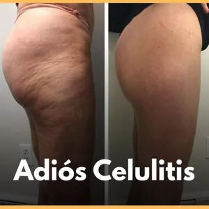 Imagen de portada para Ebook Adiós Celulitis