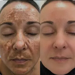 Imagem de capa para o Ebook Tratamento para o melasma 