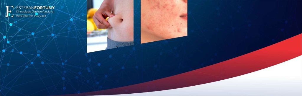 Curso avanzado en Acné y Grasa Localizada