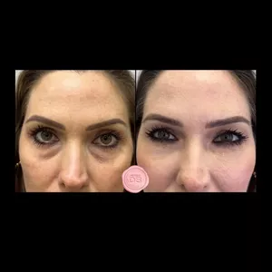 Imagem de capa para o Evento presencial Campanha grupo VIP (1 ampola para preenchimento de olheiras)