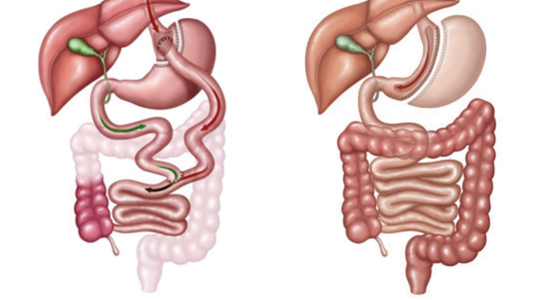 Cirurgia bariatrica: O que preciso saber ?