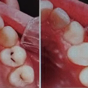 Cover image for Online course Brighten your Smile with Resin Fillings