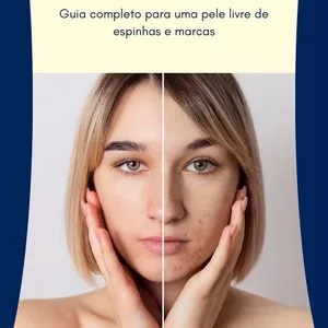 Imagem de capa para o Ebook Acne Nunca Mais !