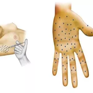 Imagem de capa para o Curso online Hiperidrose- O problema do suor excessivo 