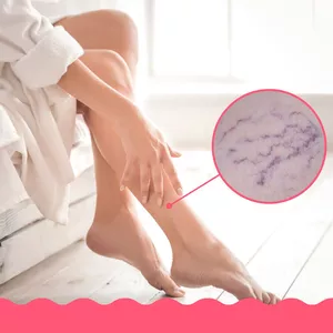 Imagen de portada para Curso online TRATAMIENTO OCULTO PARA VARICES