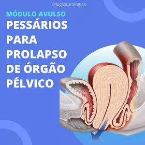 Imagem de capa para o Curso online MÓDULO AVULSO - PESSÁRIO PARA PROLAPSO