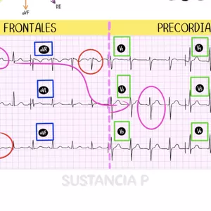 Imagen de portada para Curso online Método Sustancia P: EKG Básico