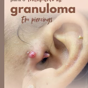Imagem de capa para o Ebook Guia completo para tratamento de granuloma em piercings