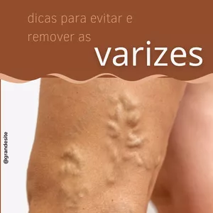 Imagem de capa para o Ebook Sem Varizes, Sem Dor: Recupere a Confiança nas Suas Pernas!