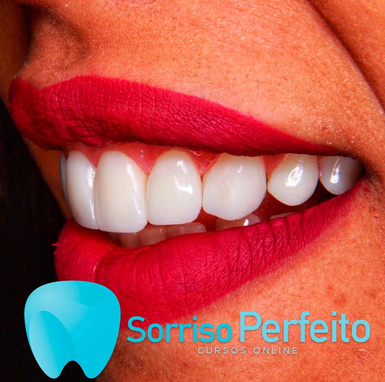 Imagem do curso Lentes em Resina composta – Passo a Passo