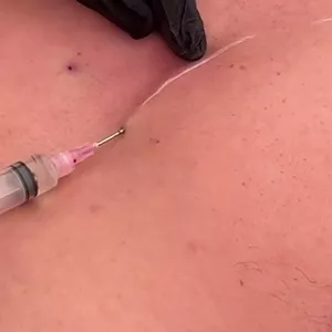 Imagem de capa para o Curso online Bioplastia Peitoral Masculina