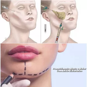 Imagem de capa para o Curso online Harmonização Facial com Ácido Hialurônico: Mento e Malar.