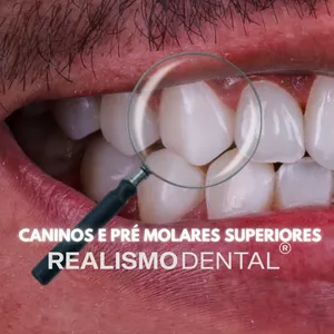 Imagem de capa para o Curso online Facetas em Resina Composta (caninos e pré molares superiores