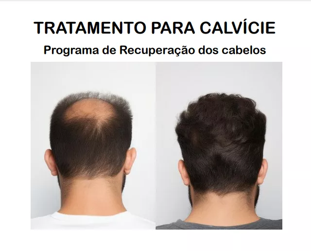 TRATAMENTO PARA CALVÍCIE