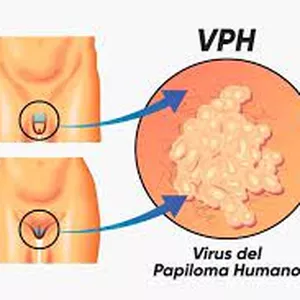 Imagen de portada para Ebook Virus Papiloma Humano - Protocolo de Sanación