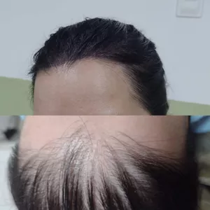 Curso CURSO DE DERMOPIGMENTAÇÃO CAPILAR FEMININA
