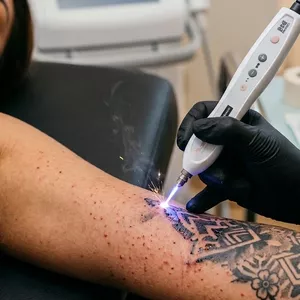 Imagem de capa para o Curso online Curso de Clareamento de Tattoo