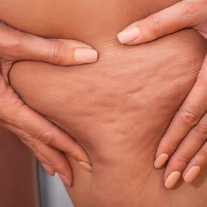 Imagen de portada para Curso online Upssel Flacidez