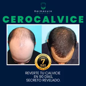 Imagen de portada para Ebook Cero Calvicie