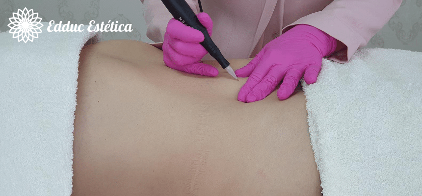 Regenera Estrias e Cicatrizes