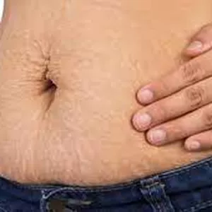 Imagem de capa para o Ebook MELHOR FORMA PARA TIRAR AS ESTRIAS EM CASA 