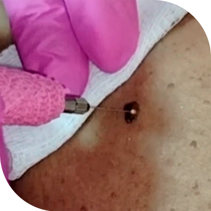 Cauterização de Verrugas